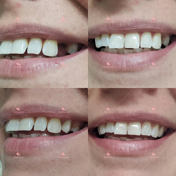 Permanently Flexible/TCS partial denture *Impression kit included*