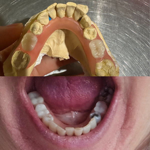Permanently Flexible/TCS partial denture *Impression kit included*