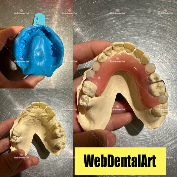 Flipper, Partial denture Impression Kit