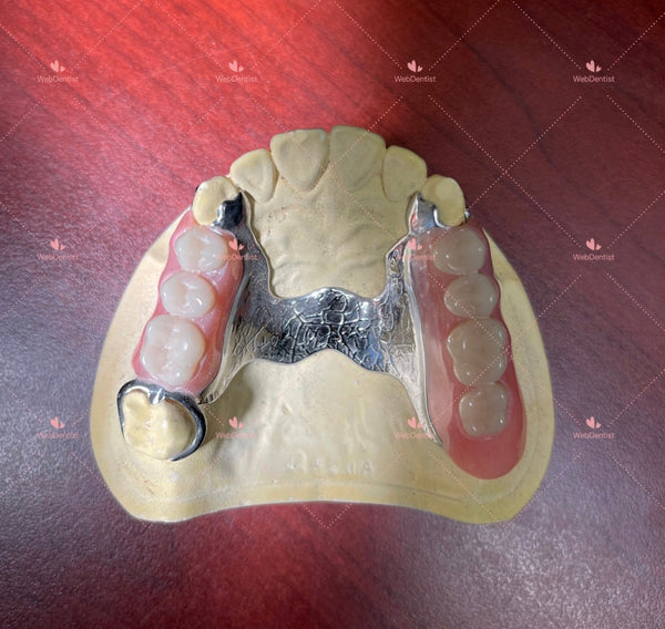 Permanently  Custom Made High Quality Upper/Lower Partial Denture w/Metal *Impression kit INCLUDED*