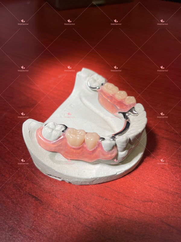 Permanently  Custom Made High Quality Upper/Lower Partial Denture w/Metal *Impression kit INCLUDED*
