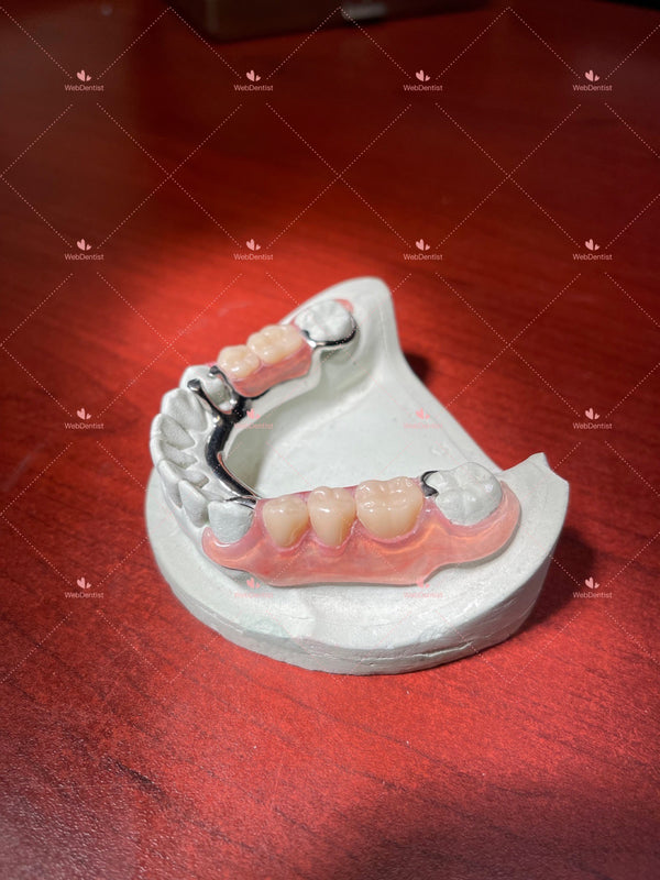 Permanently  Custom Made High Quality Upper/Lower Partial Denture w/Metal *Impression kit INCLUDED*