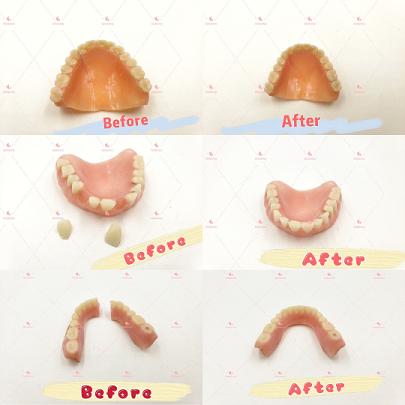 Denture Repair/Add tooth/Add mesh
