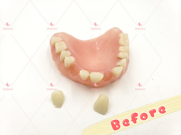 Professional Denture & Partial Repair for existing partial denture