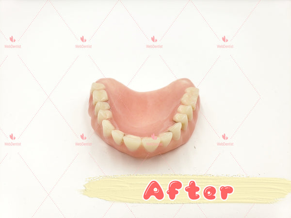 Professional Denture & Partial Repair for existing partial denture