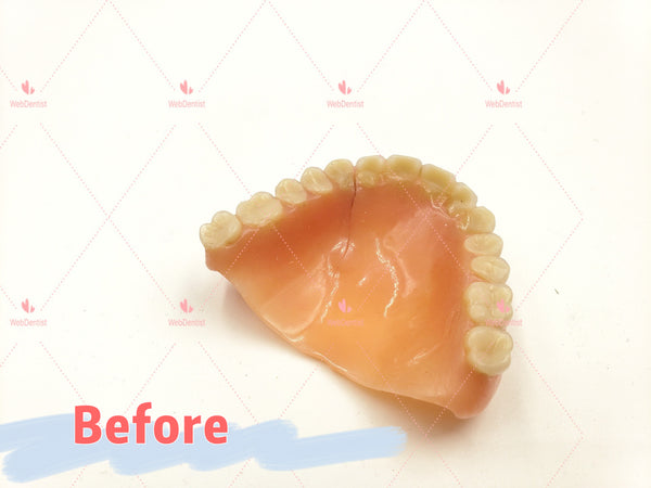 Professional Denture & Partial Repair for existing partial denture