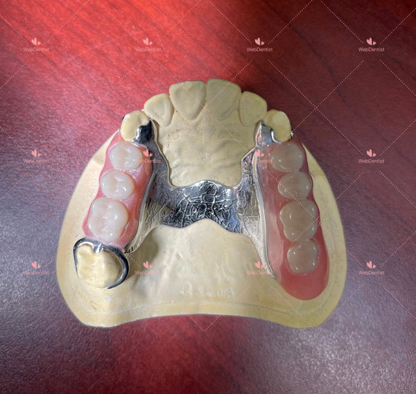 Permanently  Custom Made High Quality Upper/Lower Partial Denture w/Metal *Impression kit not included*