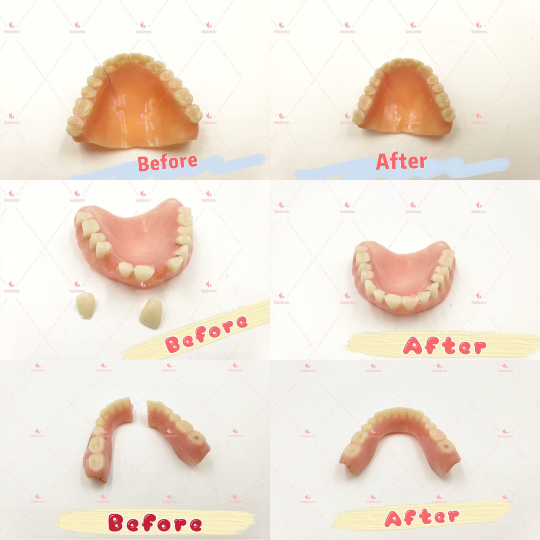 Professional Denture & Partial Repair for existing partial denture